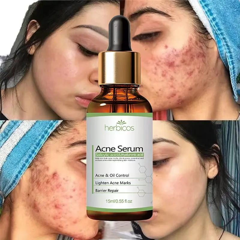 Private Label 2% Salicylic Acid Acne Serum Pimple Remover Natural Oil Control & Barrier Repair Essence Anti-Blemish Treatment