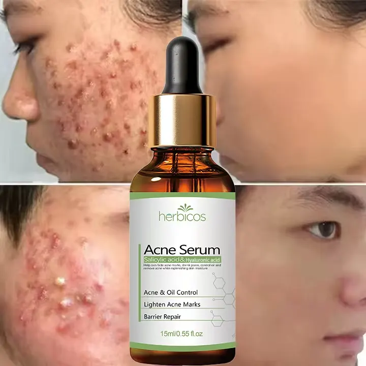 Private Label 2% Salicylic Acid Anti Acne Serum Oil Control Shrink Pores Repair Acne Scar for Oily Sensitive Acne Prone Skin OEM