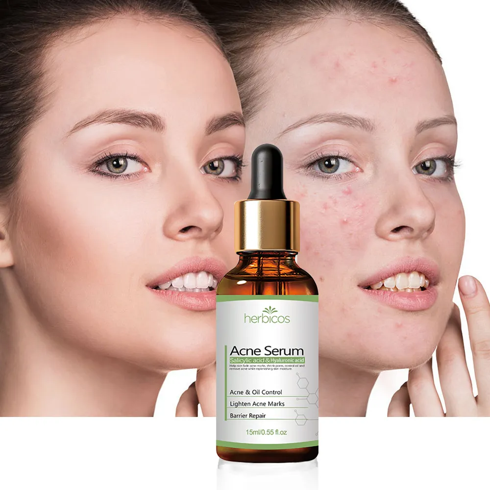 Private Label 2% Salicylic Acid Anti Acne Serum Oil Control Shrink Pores Repair Acne Scar for Oily Sensitive Acne Prone Skin OEM