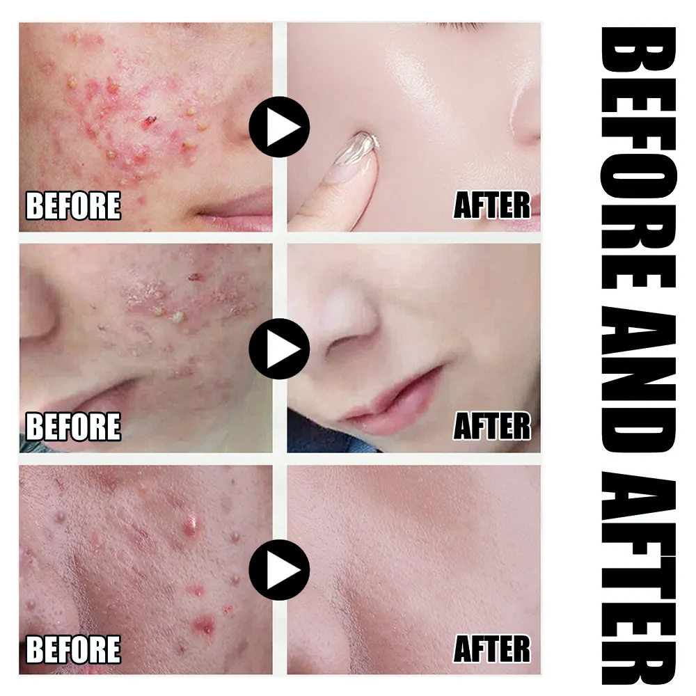 Private Label 2% Salicylic Acid Anti Acne Serum Oil Control Shrink Pores Repair Acne Scar for Oily Sensitive Acne Prone Skin OEM