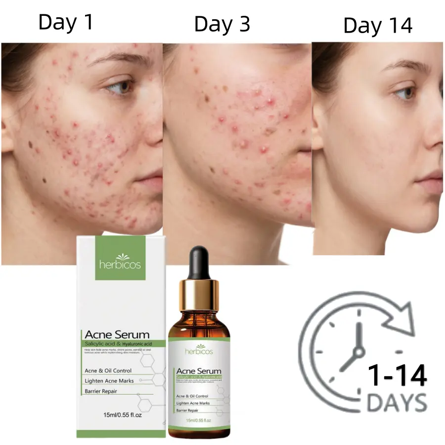 2% Salicylic Acid Anti-Acne Serum BHA Niacinamide Face Treatment Scar Removal Fade Acne Marks Soothe Redness Private Label OEM