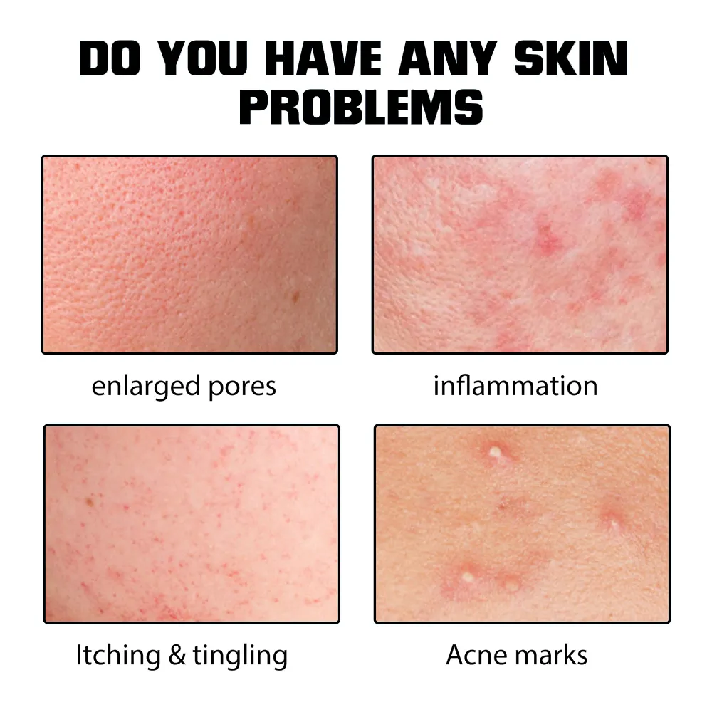 2% Salicylic Acid Anti-Acne Serum BHA Niacinamide Face Treatment Scar Removal Fade Acne Marks Soothe Redness Private Label OEM