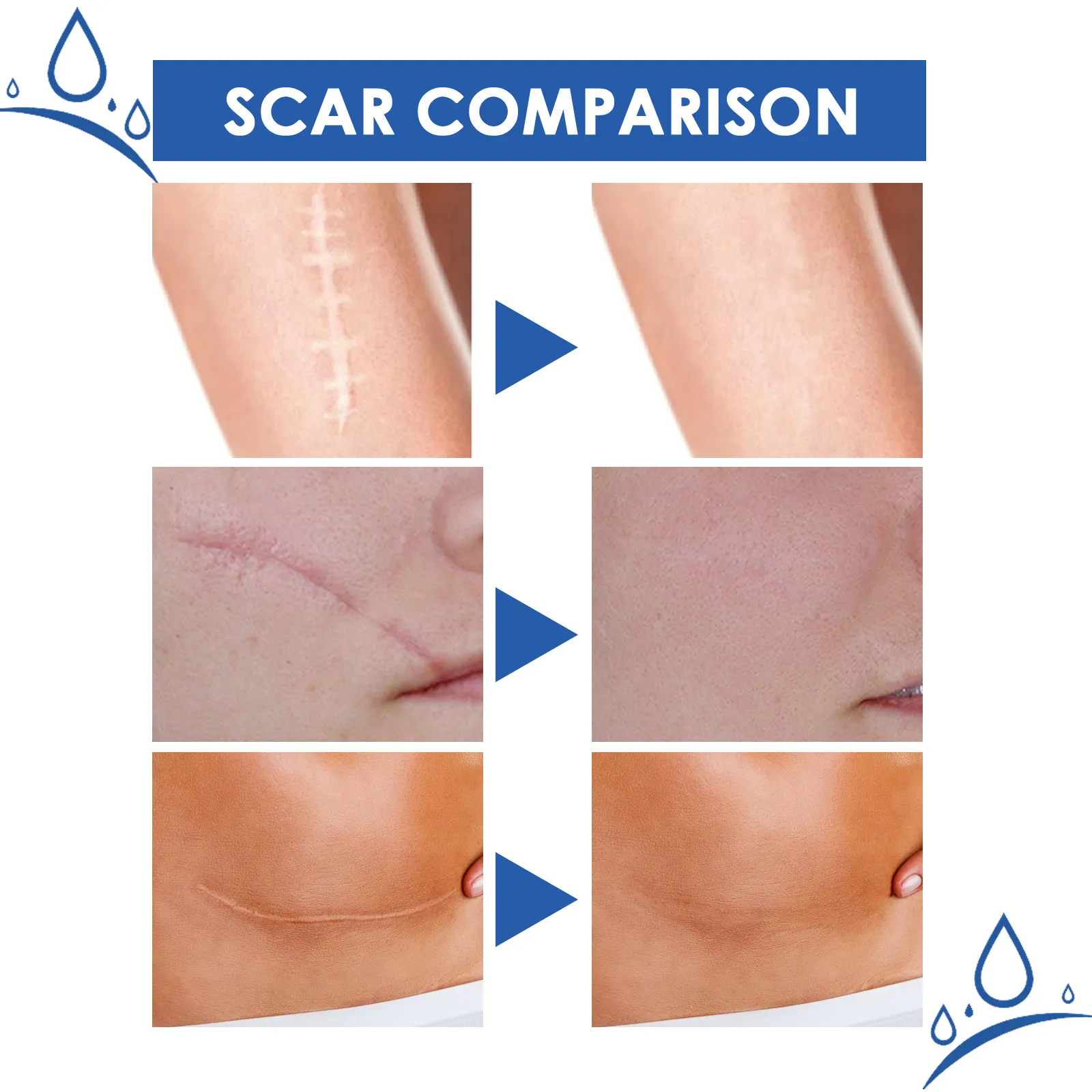 Customized logo Private Label Fastest Scar Removal Gel Bruises Repair Reduce Stretch Marks Scar Repair Cream Oem