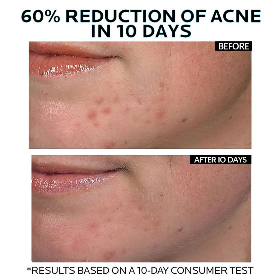Herbicos Private Brand Wholesale Acne Skin Care Products Customized Plant Extracts Bleach Facial Skin Care Anti-Acne Cream