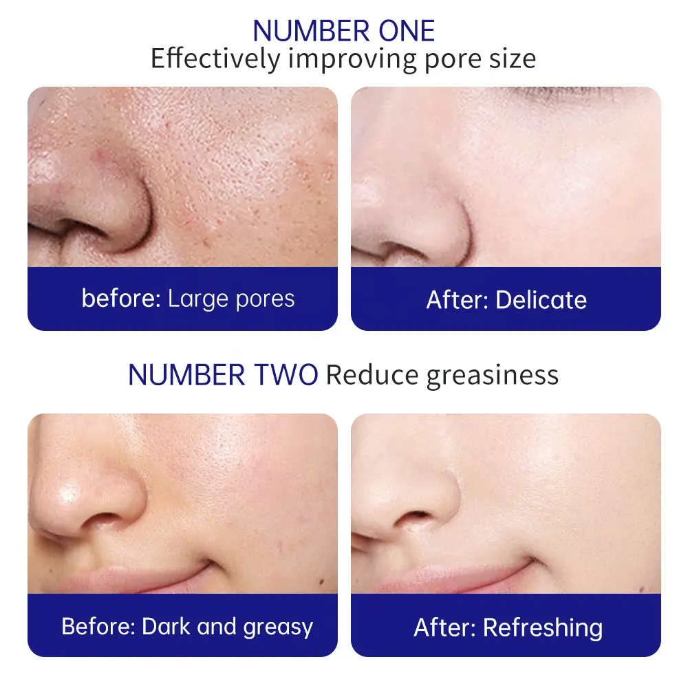 BISUTANG Sheet Face Mask Form Salicylic Acid Oil Control Facial Mask for Face Hyaluronic Acid Herbal Ingredients Cotton Material