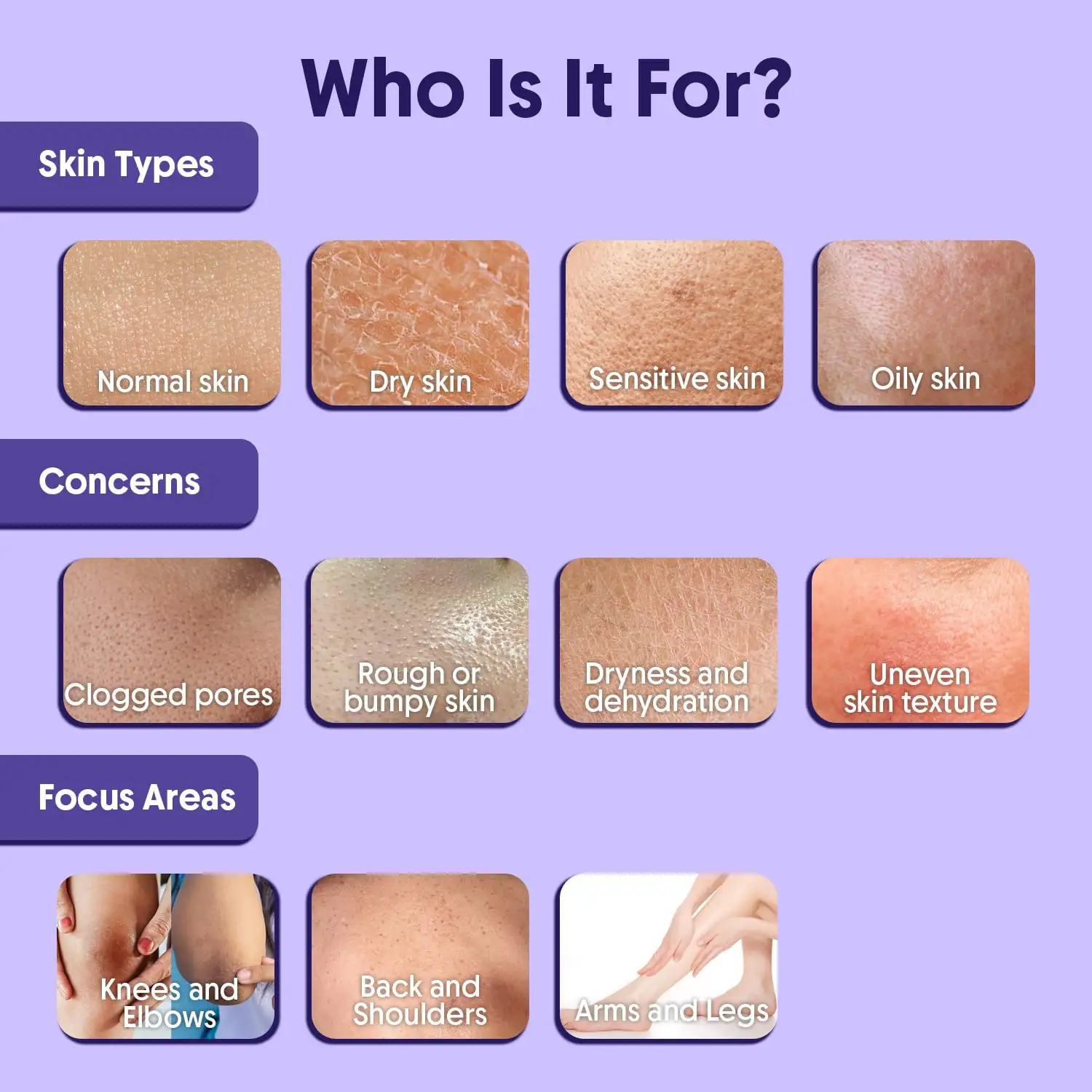 12% Glycolic Acid Exfoliating Moisturizer Treats Back Acne, KP & Dryness Lactic, Citric Acids AHA Body Lotion