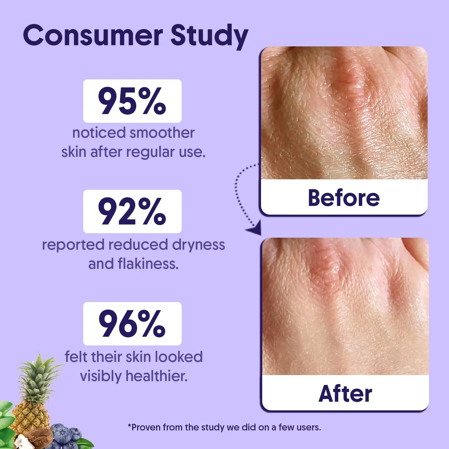 12% Glycolic Acid Exfoliating Moisturizer Treats Back Acne, KP & Dryness Lactic, Citric Acids AHA Body Lotion